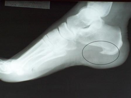 Picture of heel X-ray in Bronx, NY
